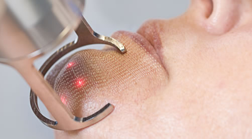 Mei SPA Studio fractional laser rejuvenation 2