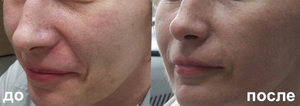 Mei SPA Studio fractional laser rejuvenation 3