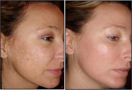 Mei SPA Studio fractional laser rejuvenation 4