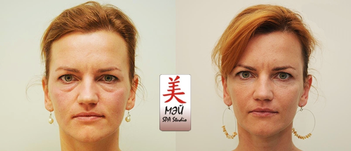 Mei SPA studio mezoterapiya 5