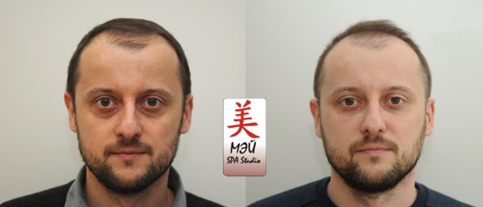 Mei SPA studio mezoterapiya 6