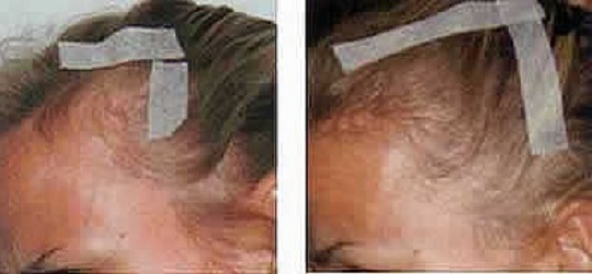 DermaOXY 5