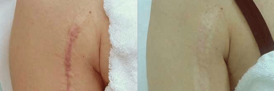 Mei SPA Studio udalenie shramov 1