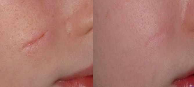 Mei SPA Studio udalenie shramov 4