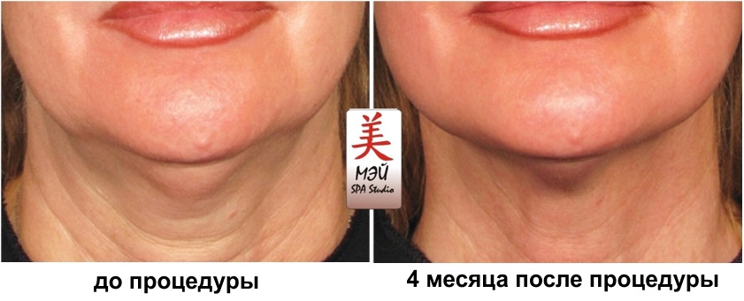 HIFU rezultati Mei SPA Studio 1