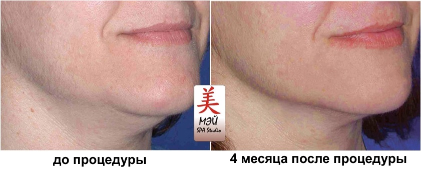 HIFU rezultati Mei SPA Studio 2