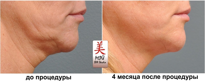 HIFU rezultati Mei SPA Studio 3