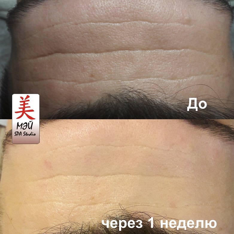 ПДРН в Мей результат після 1 тижня