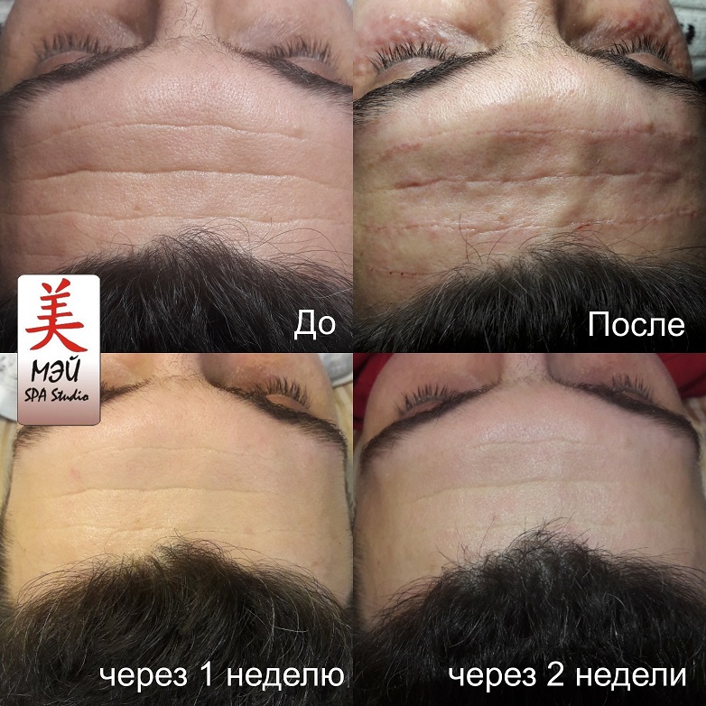 ПДРН результат процедур