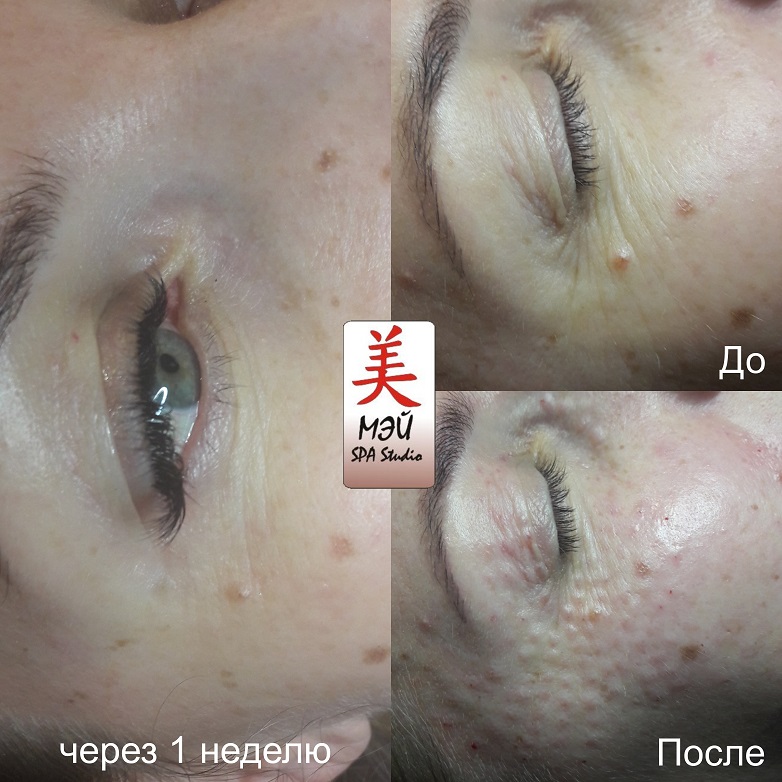 ПДРН в Мей результат процедур